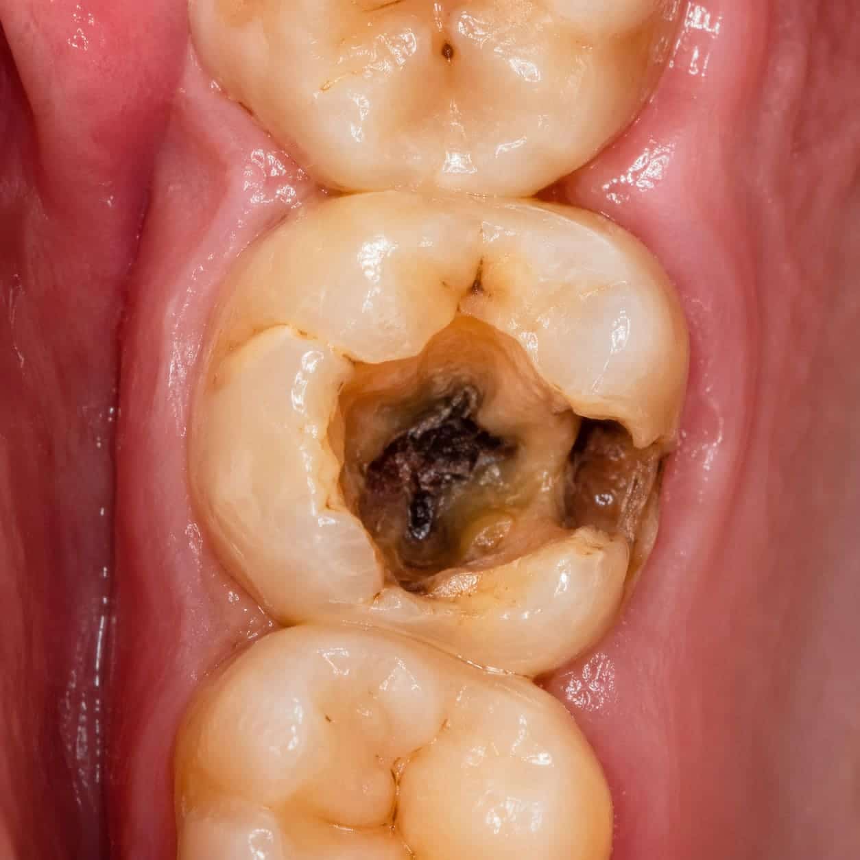 Caries profunda