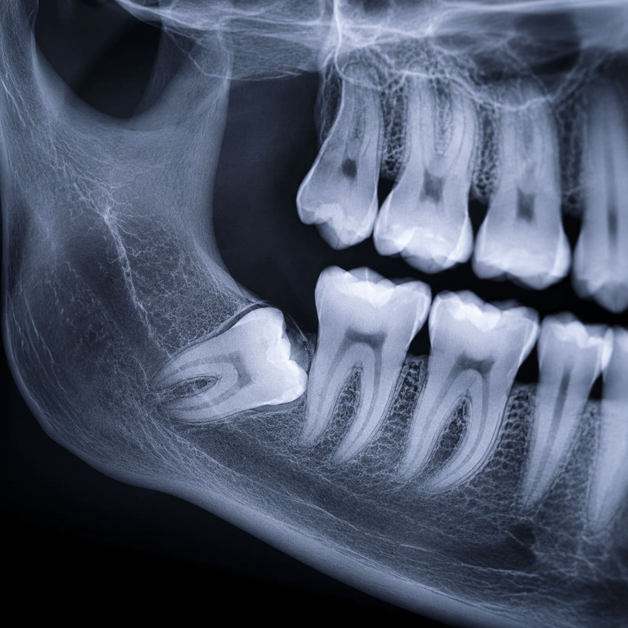 Dientes retenidos