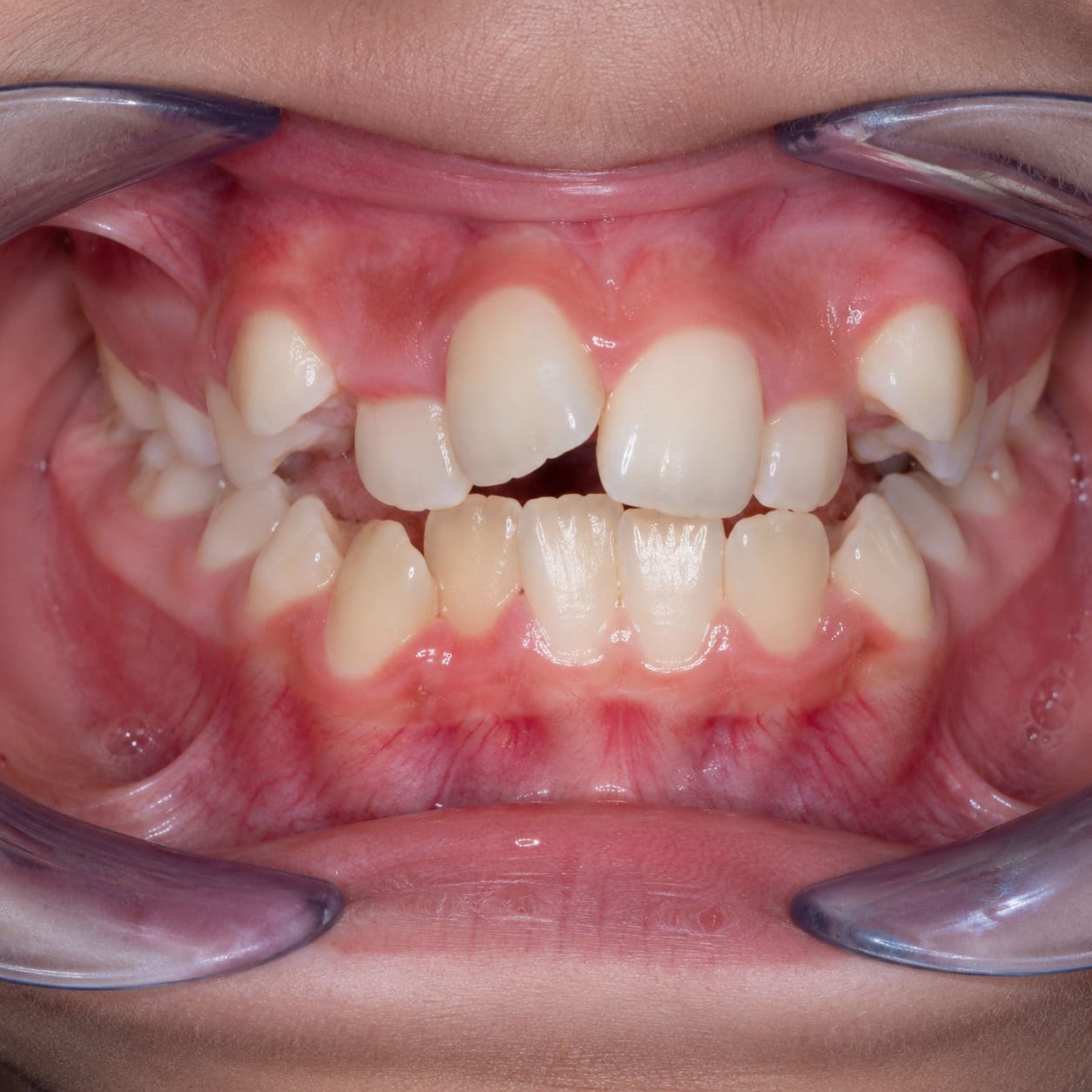 Falta de espacio dental