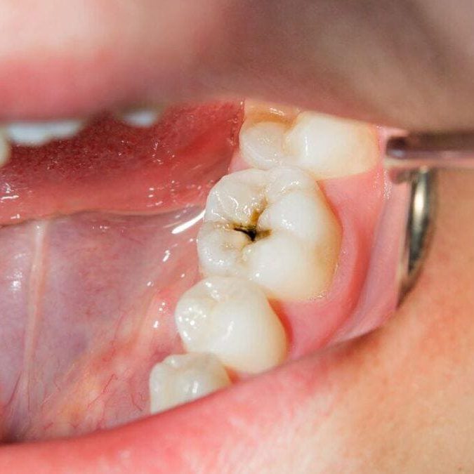 caries