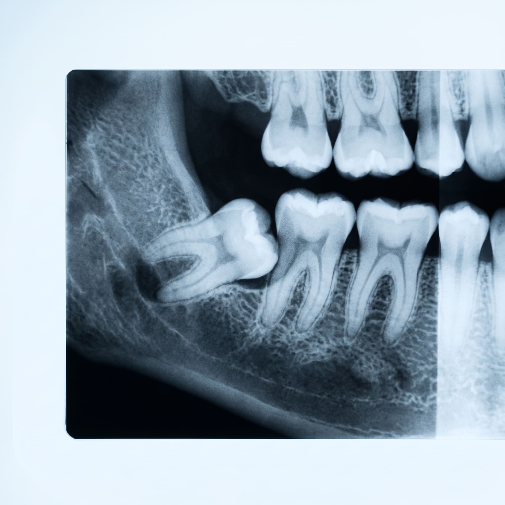 Radiografía que muestra una muela del juicio retenida y en posición horizontal contra el molar vecino.